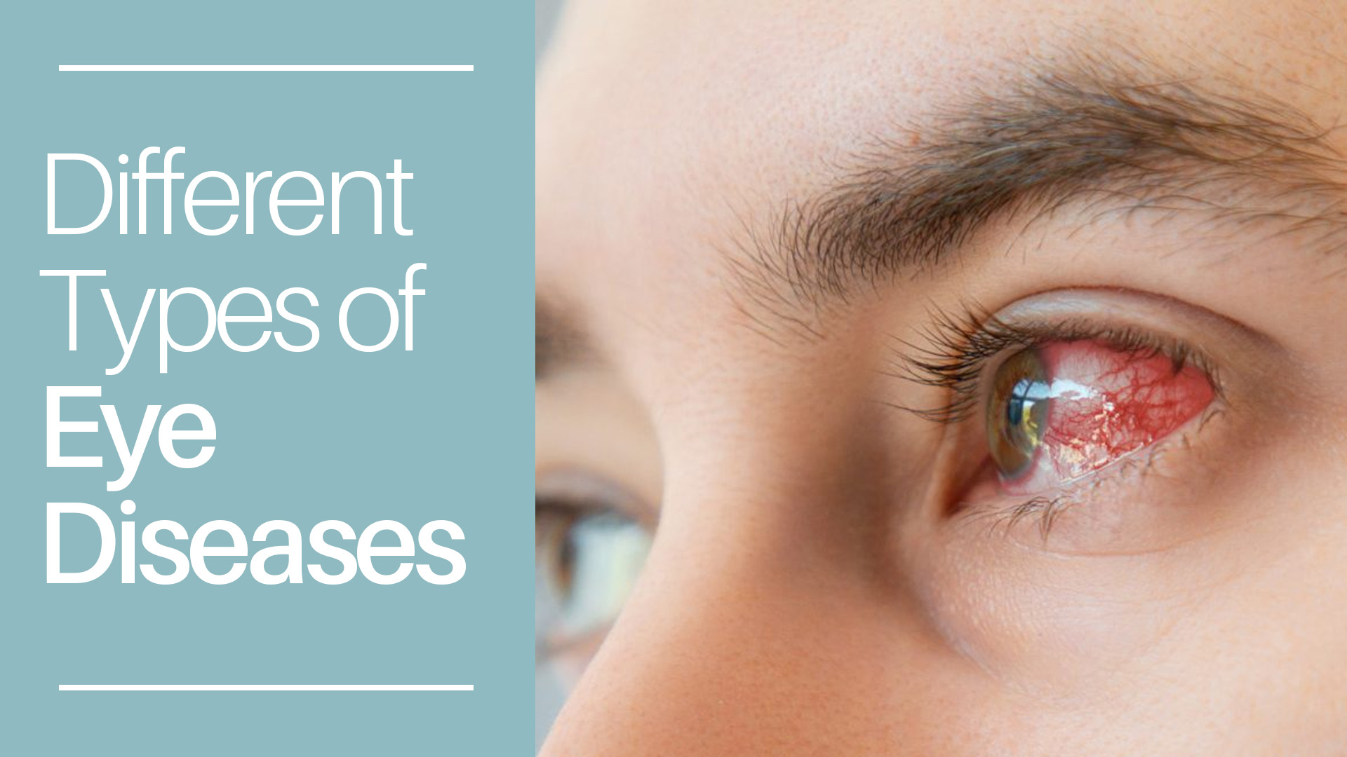 Different Types of Eye Diseases